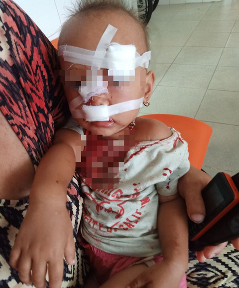 Mẹ bé gái bị cha ruột ném ly vào mặt, khâu 12 mũi: Lúc 13 tháng, con bé cũng bị ném vật cứng làm chấn thương sọ não - Ảnh 3. Mẹ bé gái bị cha ruột ném ly vào mặt, khâu 12 mũi: Lúc 13 tháng, con bé cũng bị ném vật cứng làm chấn thương sọ não - Ảnh 3.