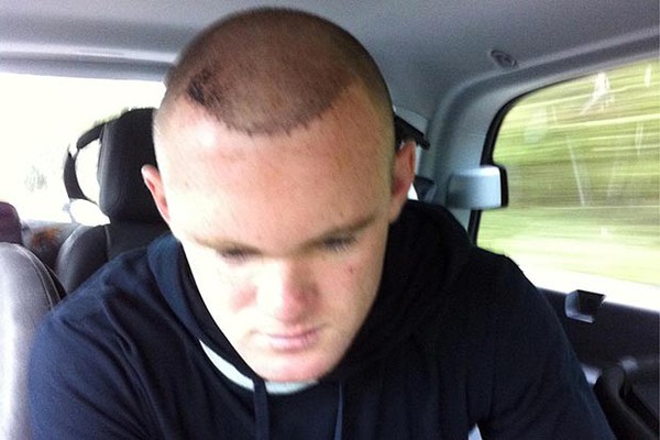 Rooney khoe thành quả chữa hói lần 2