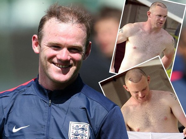 
	Mái tóc của Rooney trước kia (trái) và  ở thời điểm hiện tại sau ca cấy ghép