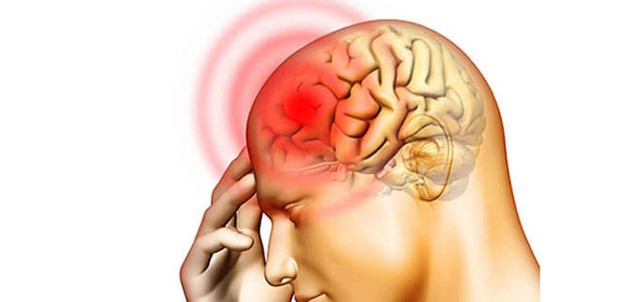 5 kiểu đau đầu cảnh báo nguy hiểm, nếu có cần đi khám ngay - Ảnh 1.