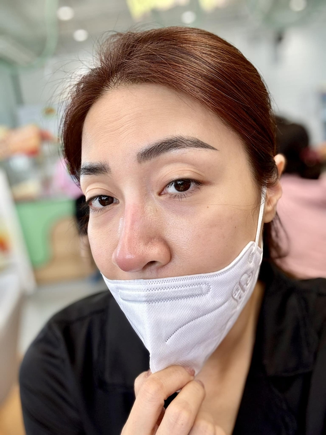 Ca sĩ Việt thông báo mũi viêm nặng sau 12 năm dao kéo, đi bác sĩ không dám gây mê dù 