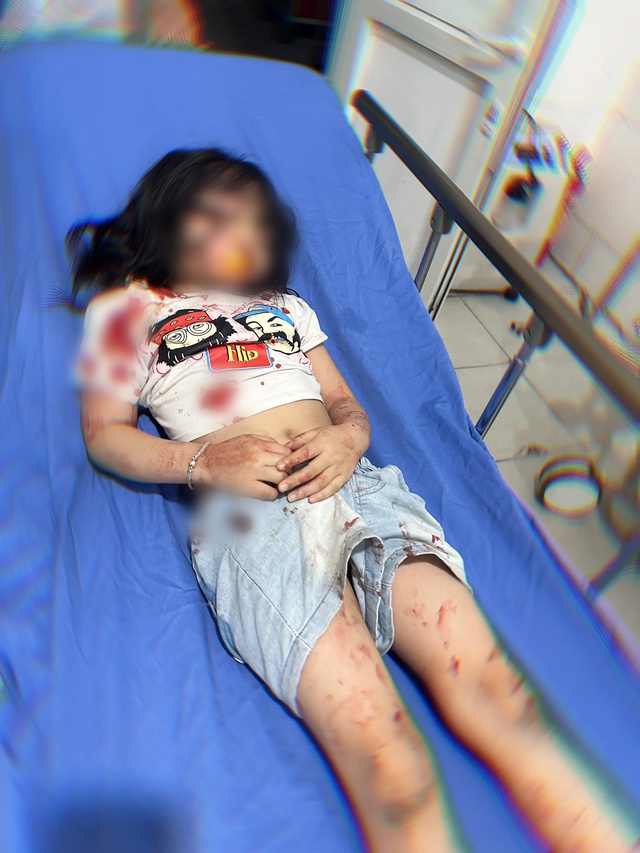 Bé 5 tuổi ở Hà Giang bị chó cắn trọng thương: Người mẹ bủn rủn khi thấy con bê bết máu - Ảnh 1.