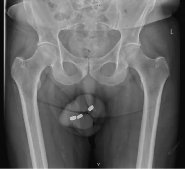 Xem ảnh X-quang của nam bệnh nhân, bác sĩ sốc khi phát hiện dị vật ở chỗ không ngờ- Ảnh 2.