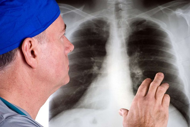 Không bao giờ hút thuốc vẫn có thể bị ung thư phổi: Đây là 11 dấu hiệu cảnh báo nguy hiểm- Ảnh 1.