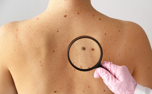 Rùng mình trước clip mô tả dấu hiệu cảnh báo ung thư ác tính, có thể xuất hiện trên da trước 10 năm- Ảnh 1.