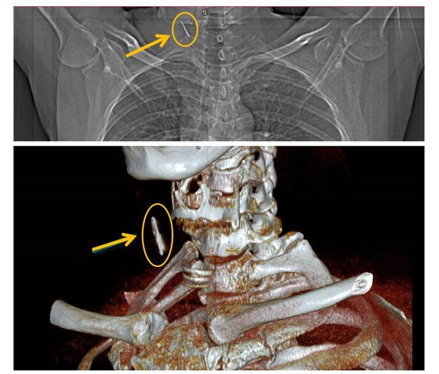 Xem ảnh chụp X-quang, bác sĩ bất ngờ phát hiện 1 thứ nằm trong cổ bệnh nhân hơn chục năm- Ảnh 1.