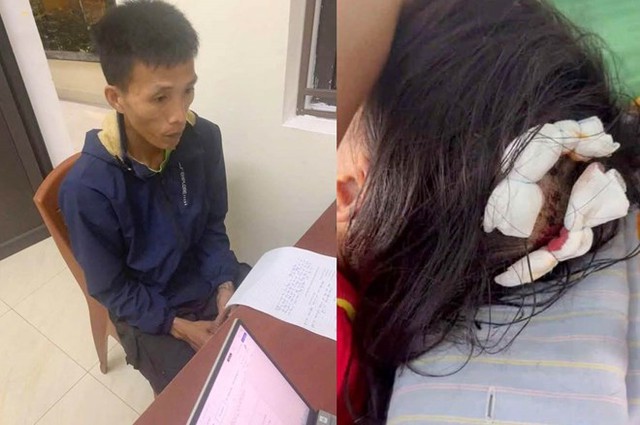 Sức khỏe của bé gái bị cha dượng dùng búa đánh vào đầu hiện ra sao?- Ảnh 2.