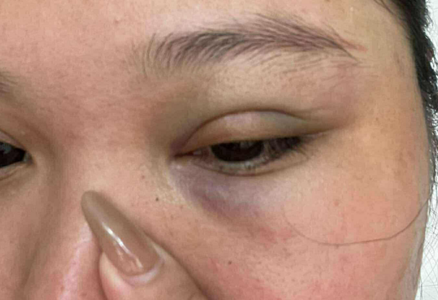 Hà Nội: Người phụ nữ tố bị thanh niên lạ mặt đánh gẫy xương hốc mắt, hé lộ nguồn cơn đầy bất bình- Ảnh 2.