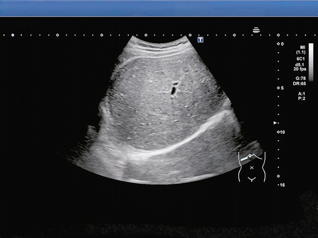 Nam sinh có gan trắng xoá, ngập trong mỡ: Bác sĩ nói thẳng “do 2 món khoái khẩu nhiều người mê”- Ảnh 1. Nam sinh có gan trắng xoá, ngập trong mỡ: Bác sĩ nói thẳng “do 2 món khoái khẩu nhiều người mê”- Ảnh 1.