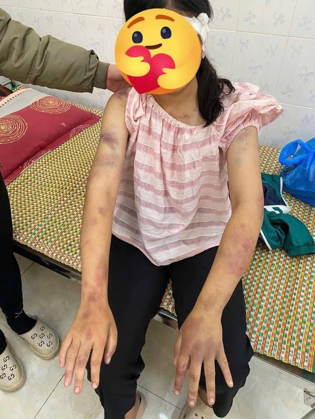 Hoàn cảnh cháu bé bị bà nội và 2 người đàn ông bạo hành: Bố mẹ ly hôn khi mới 1 tuổi, kể bị đánh 4 tiếng- Ảnh 2. Hoàn cảnh cháu bé bị bà nội và 2 người đàn ông bạo hành: Bố mẹ ly hôn khi mới 1 tuổi, kể bị đánh 4 tiếng- Ảnh 2.