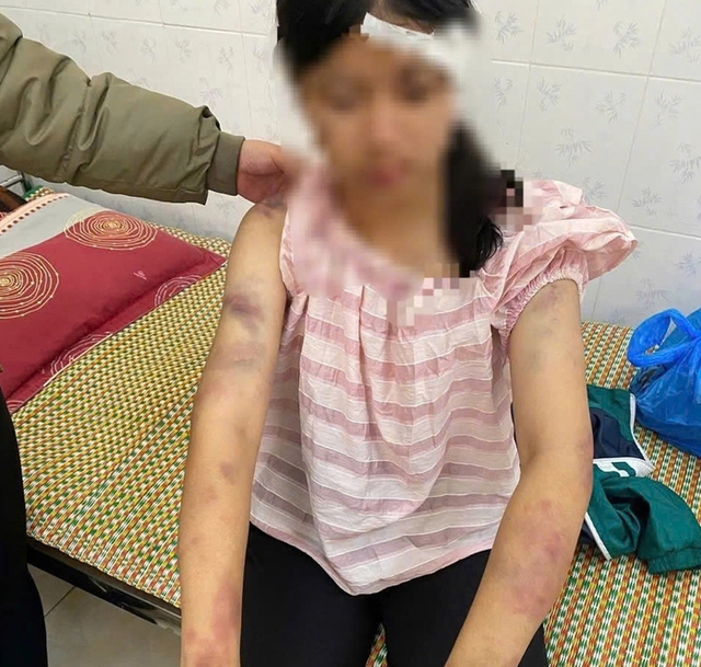 Bé gái bị gia đình nội tra tấn: Đây là hành vi nghiêm trọng- Ảnh 1.