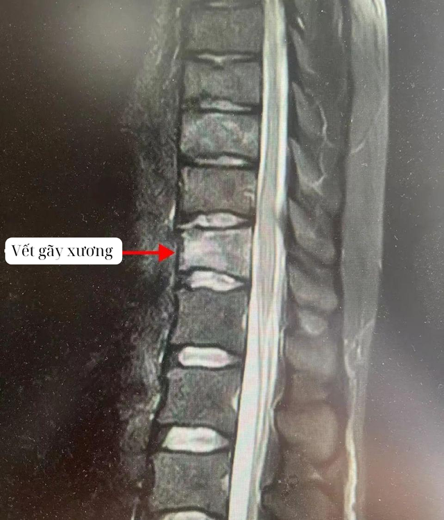 Đang khỏe mạnh, cô gái 25 tuổi bỗng phải nằm liệt giường vì kiểu uống cà phê nhiều người mắc - Ảnh 1.