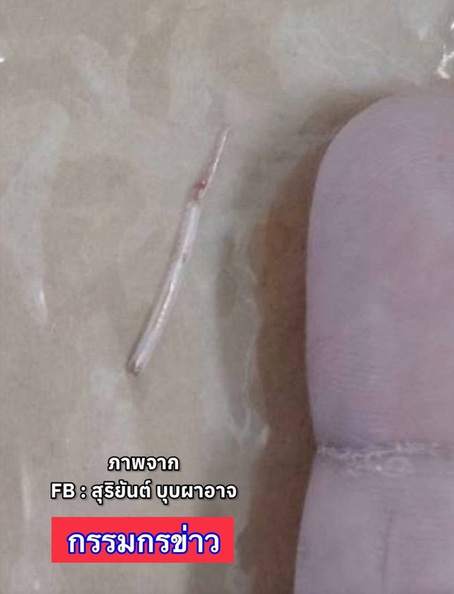 Người phụ nữ vô tình nuốt phải xương cá trong lúc ăn canh, 2 tuần sau chuyện kinh khủng xảy ra - Ảnh 3.