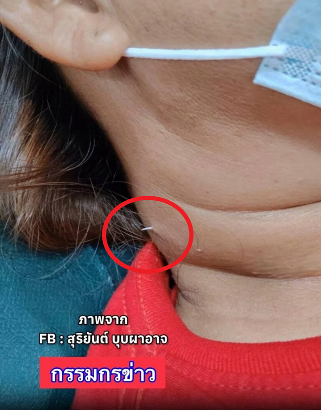 Người phụ nữ vô tình nuốt phải xương cá trong lúc ăn canh, 2 tuần sau chuyện kinh khủng xảy ra - Ảnh 2.