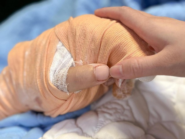 Nam TikToker ở Thái Nguyên bị chém gần đứt lìa bàn tay: Bác sĩ thông báo tin quan trọng - Ảnh 1.