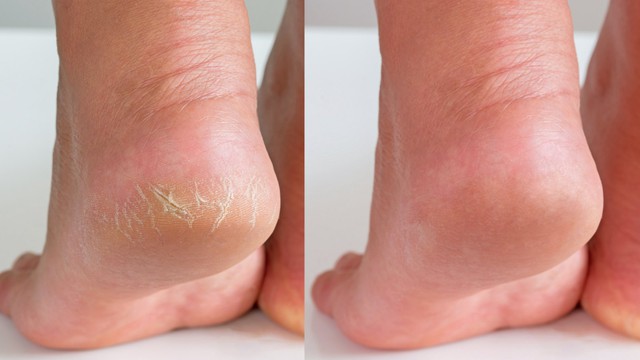 Muốn biết gan khoẻ hay yếu cứ nhìn vào chân sẽ rõ: Có 1 trong 5 dấu hiệu này nên đi khám ngay! - Ảnh 3.