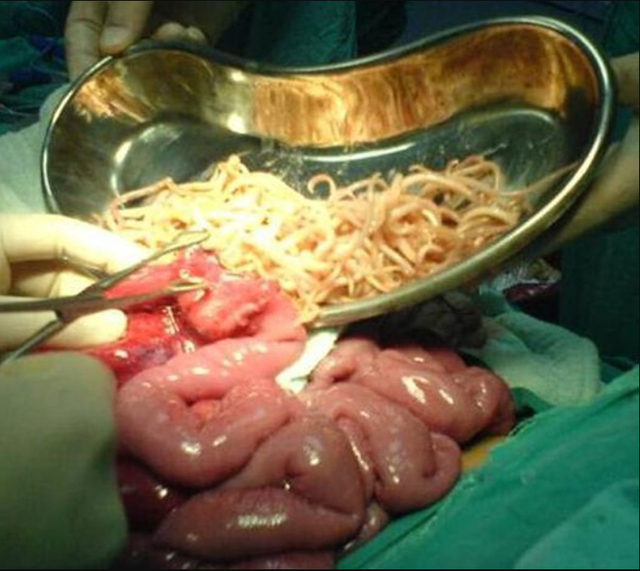 Bé trai đau bụng dữ dội, nôn ói suốt 3 ngày: Bác sĩ mổ khẩn, phát hiện thứ khó tin chặn kín ruột - Ảnh 3.