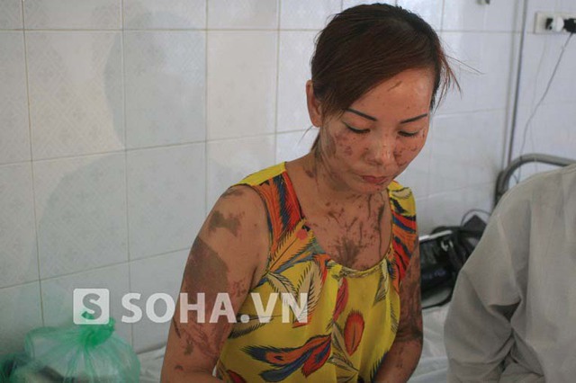 Sự việc kinh hoàng xảy ra khiến người mẹ trẻ, chị Nguyễn Thị Thanh Hương phải hứng chịu nỗi đau cả về thể xác và tinh thần.