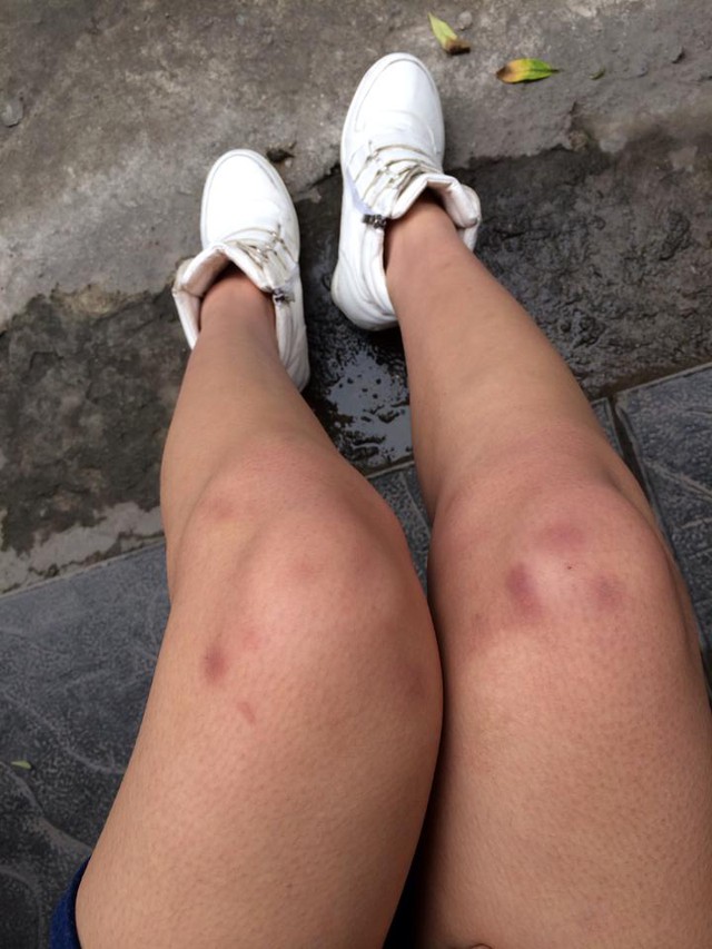 Hình ảnh đôi chân bị bầm tím Hồng Quế bị ngã lộn 4 vòng cầu thang
