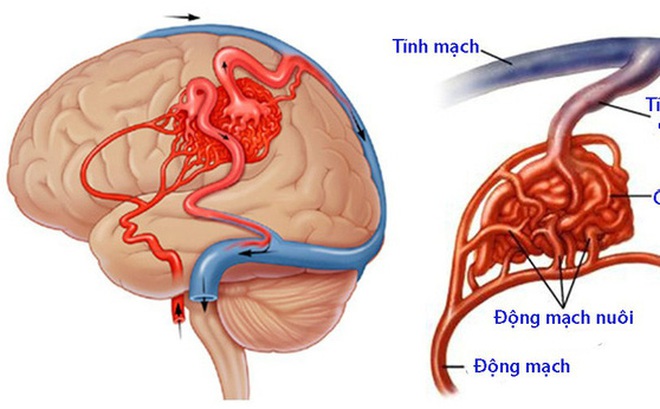 Đột quỵ não không chừa 1 ai: 2/6 thủ phạm gây bệnh là "thú vui độc hại" của nhiều người Việt