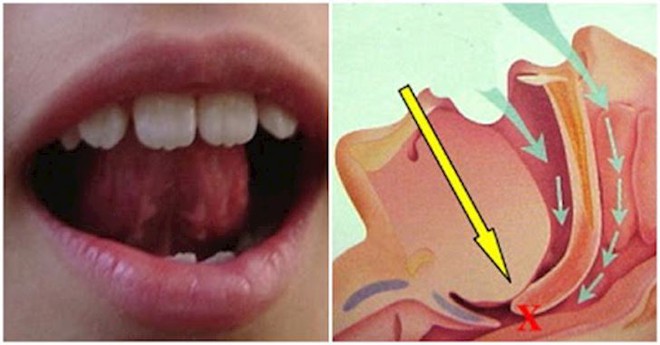 Ngủ ngáy có thể gây ra biến chứng nguy hiểm: Chuyên gia chỉ các bài tập chữa ngáy khi ngủ - Ảnh 2.