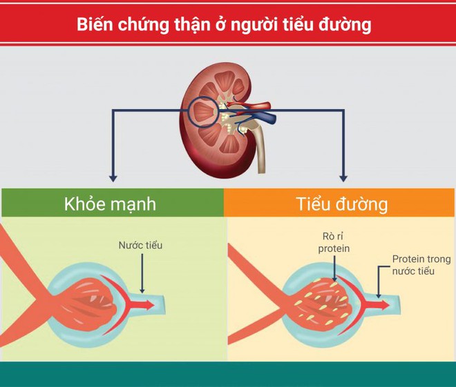 Ngăn ngừa biến chứng thận do đái tháo đường - Ảnh 1.