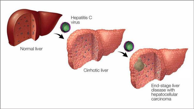 Virus viêm gan C – sát thủ thầm lặng gây ung thư gan - Ảnh 1.