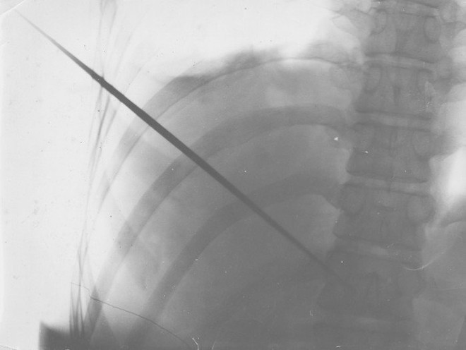 Tấm X-quang và sự thật về người 500 lần kiếm xuyên ngực không chết - Ảnh 2.