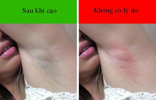 Vùng da dưới cánh tay “có mùi” cảnh báo điều gì về sức khỏe? - Ảnh 2.