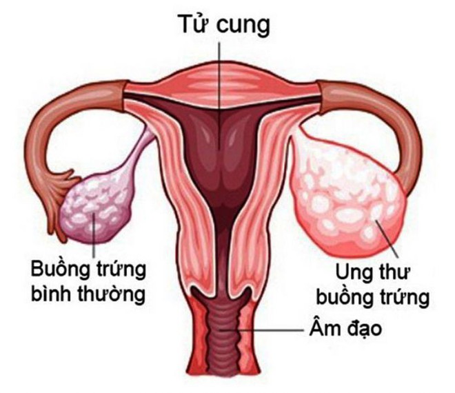 Nếu đang thừa cân, bạn có khả năng bị các loại ung thư này - Ảnh 7.