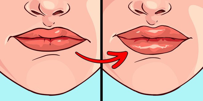 8 dấu hiệu của đôi môi tiết lộ tình trạng sức khoẻ của bạn - Ảnh 7.