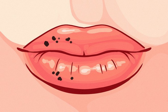 8 dấu hiệu của đôi môi tiết lộ tình trạng sức khoẻ của bạn - Ảnh 8.