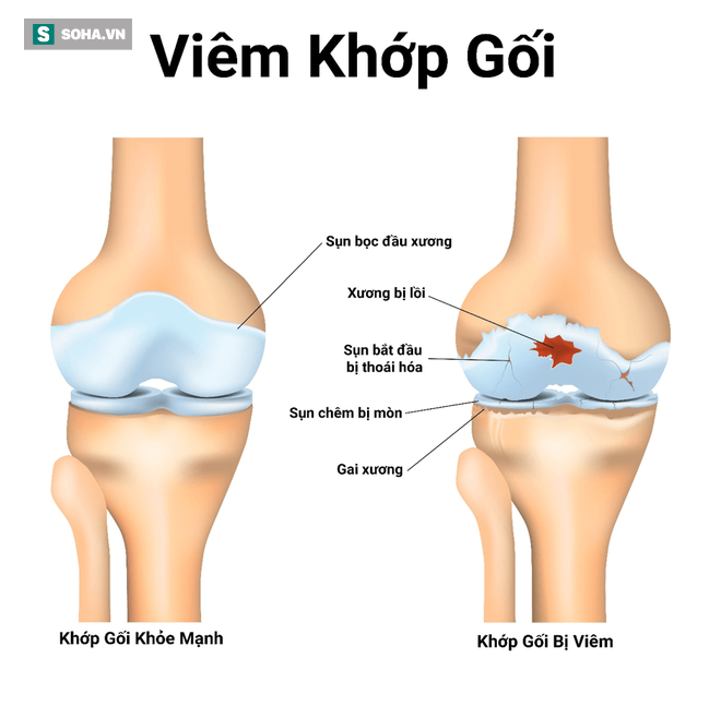 Đừng chủ quan với chứng đau đầu gối: Dấu hiệu nhận biết và cách phòng ngừa sớm - Ảnh 1. Đừng chủ quan với chứng đau đầu gối: Dấu hiệu nhận biết và cách phòng ngừa sớm - Ảnh 1.