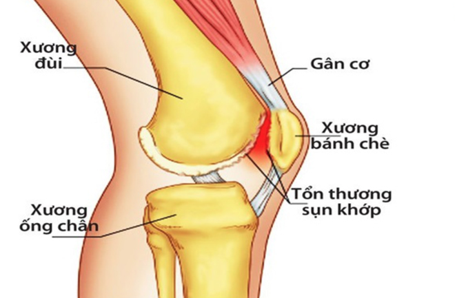 Đừng chủ quan với chứng đau đầu gối: Dấu hiệu nhận biết và cách phòng ngừa sớm - Ảnh 2. Đừng chủ quan với chứng đau đầu gối: Dấu hiệu nhận biết và cách phòng ngừa sớm - Ảnh 2.