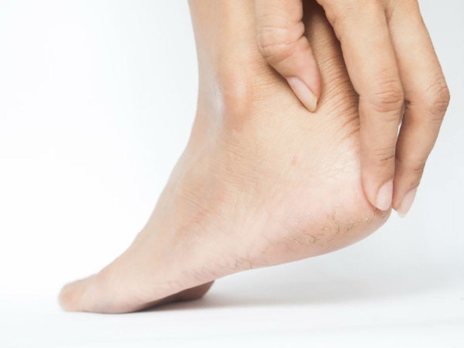 Nguyên nhân hàng đầu khiến gót chân dễ bị nứt nẻ - Ảnh 1.