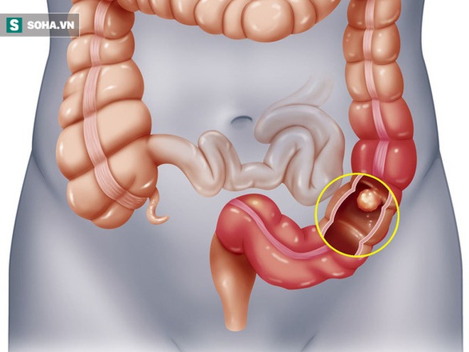 Người có 3 đặc điểm này, cần cảnh giác với mầm ung thư đại trực tràng đang lớn dần - Ảnh 1.
