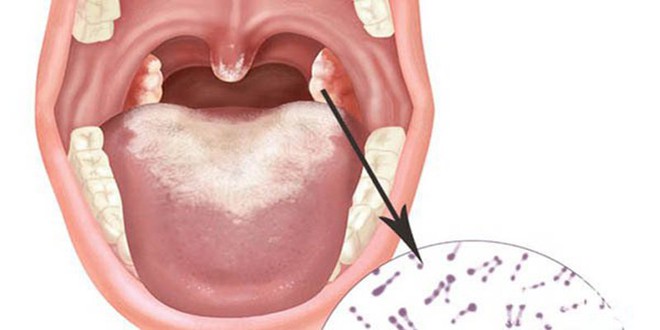 3 trẻ tử vong, Bộ Y tế yêu cầu tiêm phòng mở rộng phủ trống vùng dịch - Ảnh 1.