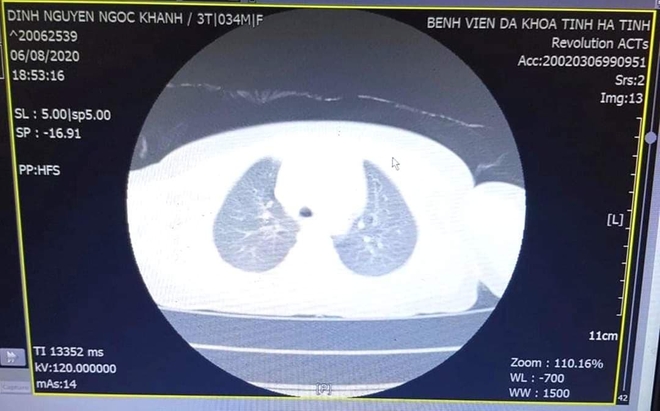 Bé 3 tuổi ho, khó thở không ngừng vì nút bấm điều khiển nằm trong khí quản - Ảnh 1.