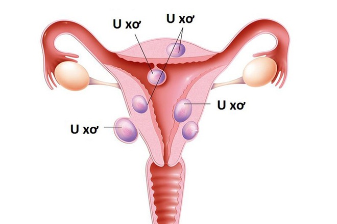 27 tuổi bị 121 khối u xơ tử cung chỉ trong hai năm: Dùng mỹ phẩm tùy tiện hay ăn uống sai? - Ảnh 1. 27 tuổi bị 121 khối u xơ tử cung chỉ trong hai năm: Dùng mỹ phẩm tùy tiện hay ăn uống sai? - Ảnh 1.