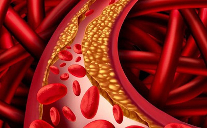 Tăng cholesterol cảnh báo mắc bệnh tuyến giáp