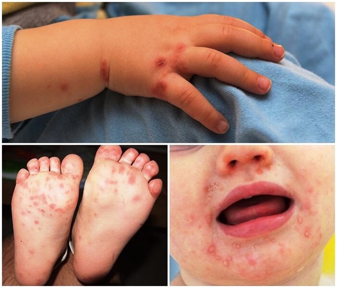 Bệnh tay chân miệng trẻ em bùng phát ở Lâm Đồng - Ảnh 1.