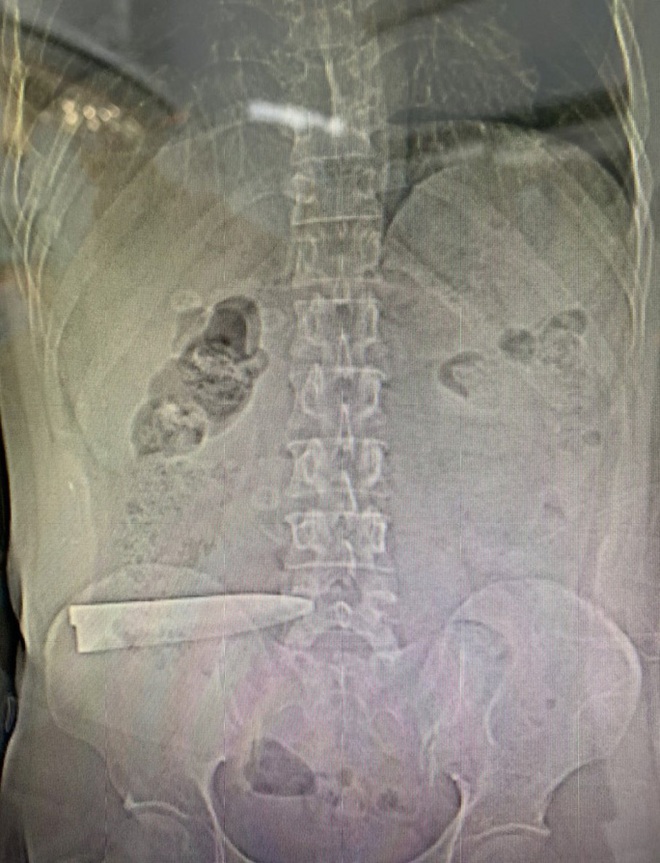 5 giờ r&uacute;t lưỡi dao g&atilde;y c&aacute;n đ&acirc;m thấu bụng, đụng cột sống người đ&agrave;n &ocirc;ng - Ảnh 1.