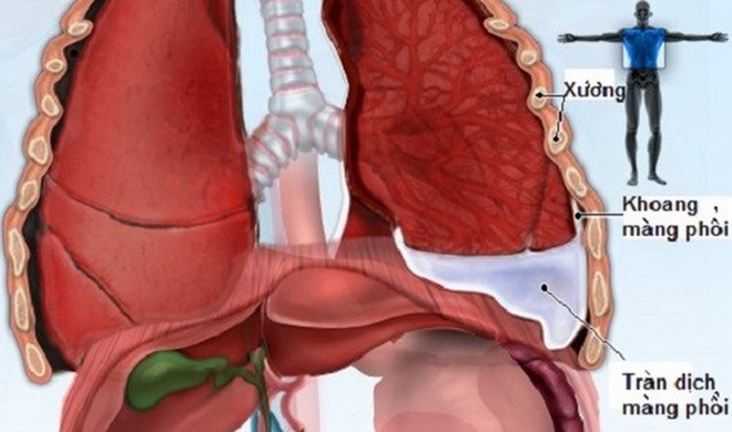 Tràn dịch màng phổi, do đâu? - Ảnh 1.