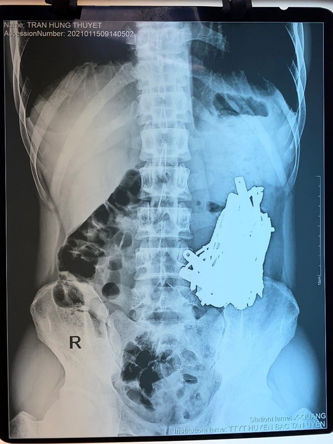 Bác sĩ choáng khi phát hiện vô số đinh, thìa, lưỡi dao trong bụng nam bệnh nhân - Ảnh 1.