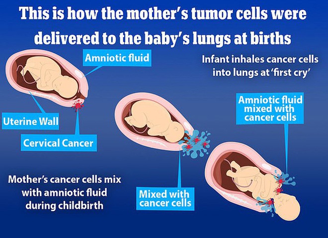 Sốc: 2 trẻ sơ sinh Nhật Bản hít phải tế bào ung thư từ mẹ - Ảnh 1.