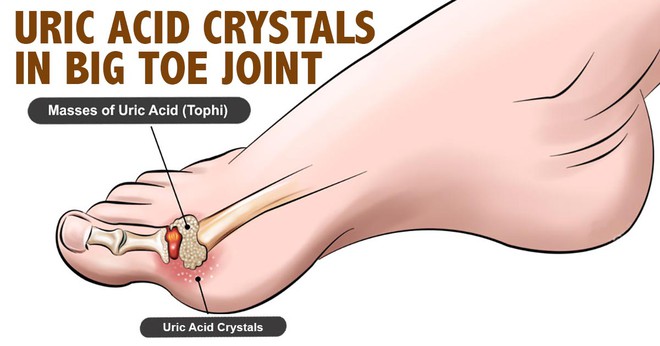 Bệnh gút thoắt ẩn thoắt hiện tái phát nhiều lần: BS nêu 6 sai lầm bạn có thể không biết - Ảnh 5.