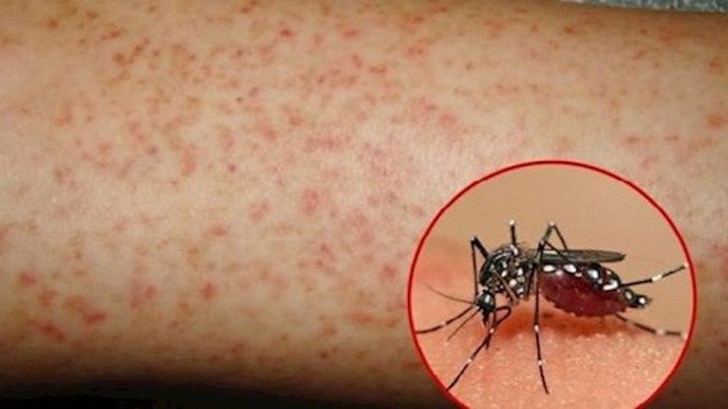 Cảnh giác với biến chứng của bệnh sốt xuất huyết Dengue - Ảnh 1.