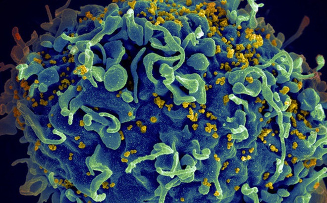 Một người phụ nữ Argentina đã tự khỏi HIV nhờ hệ miễn dịch cơ thể. Ảnh: NBC News