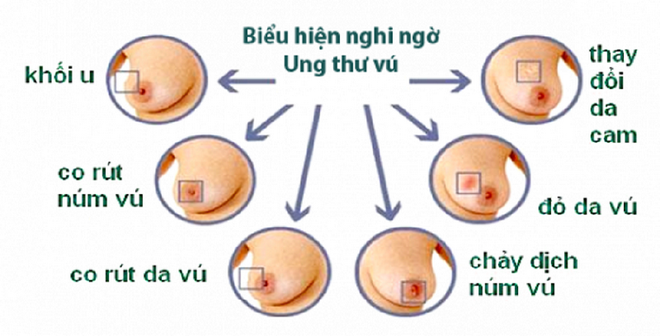 Những thực phẩm giúp ngăn ngừa ung thư vú - Ảnh 1.