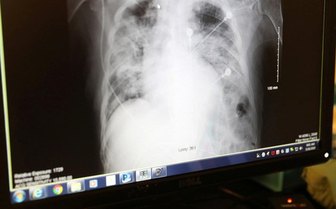 Phổi của một bệnh nhân mắc Covid-19. Ảnh: Reuters